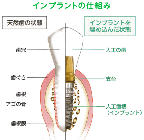 インプラントの仕組み