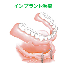 インプラント治療